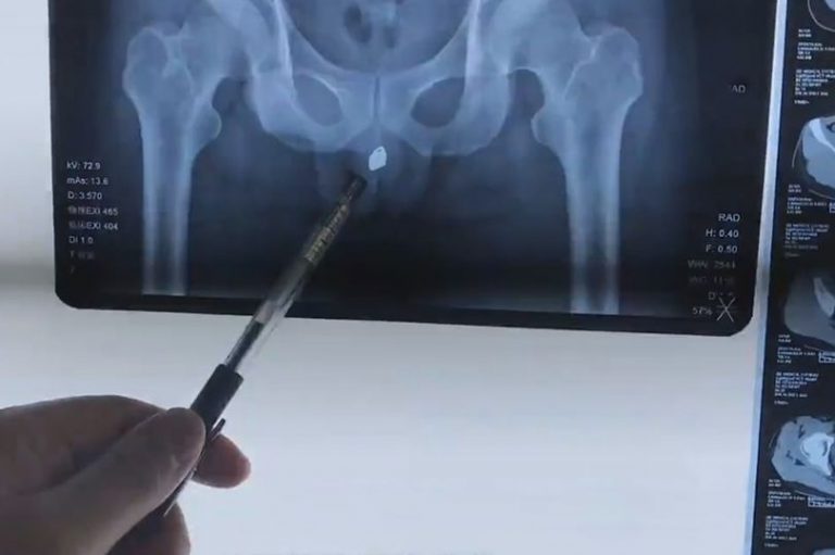 X-Ray of padlock in bladder